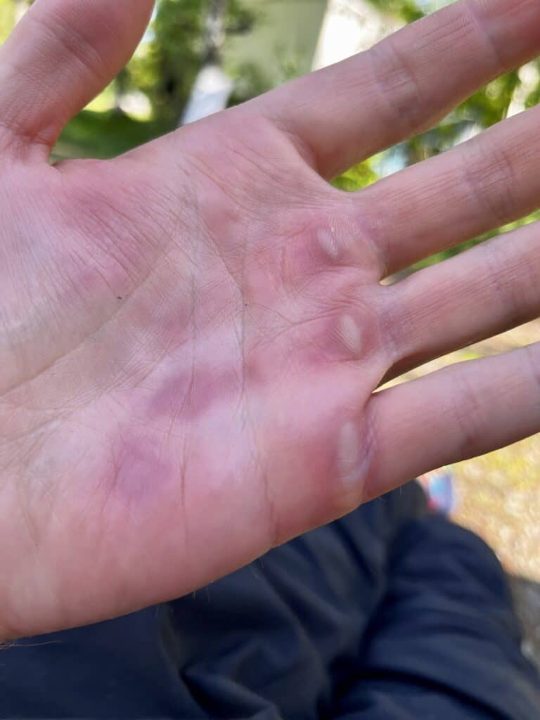No more hand blisters when Mountain Biking (8 Methods)